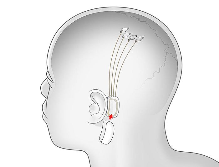 neuralink-brain-chip-implant-min